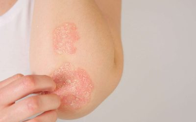Understanding Eczema: Symptoms, Diagnosis, and Treatment…