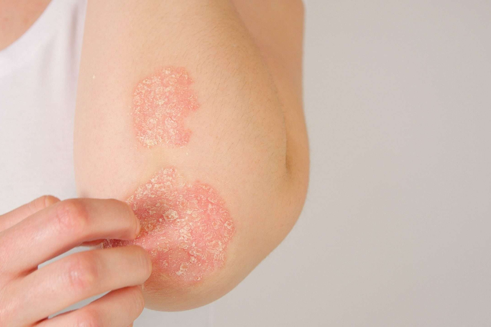 Understanding Eczema: Symptoms, Diagnosis, and Treatment…