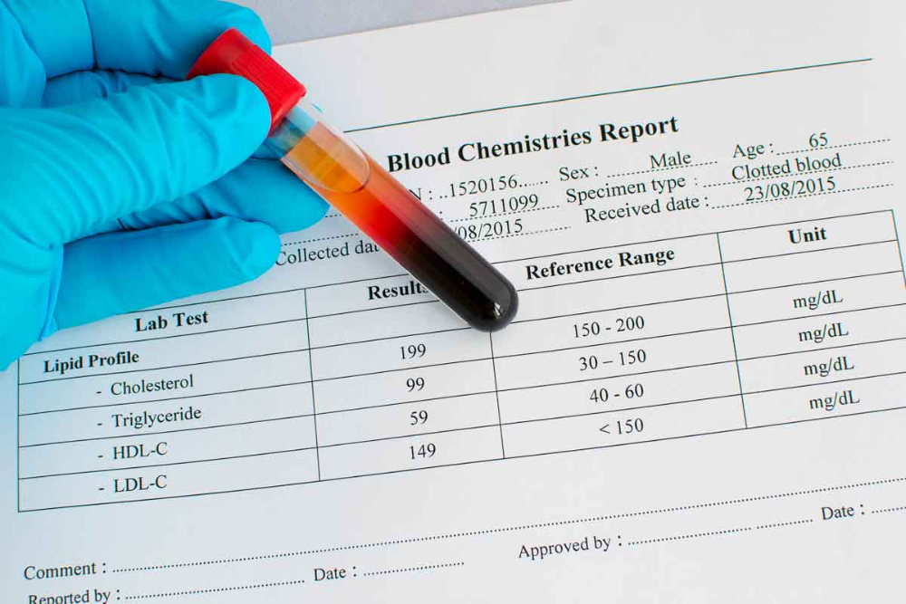 Understanding High Cholesterol: Symptoms, Causes, and Treatments…